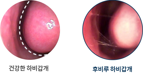 postnasal PC 이미지