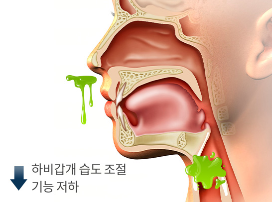 postnasal MO 이미지