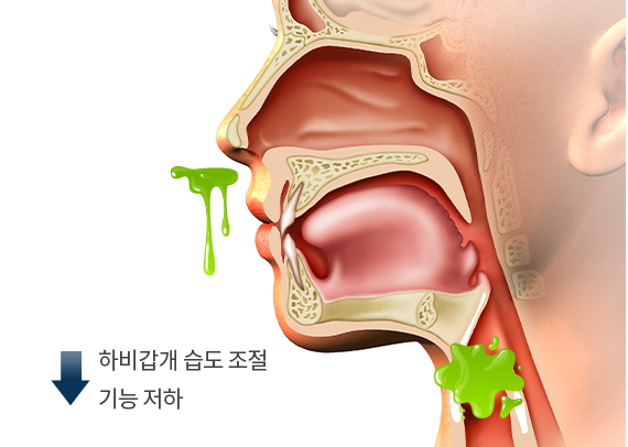 postnasal PC 이미지