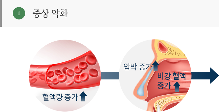 임산부비염 cause mo 이미지